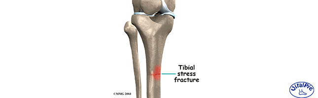 fractura-tibial
