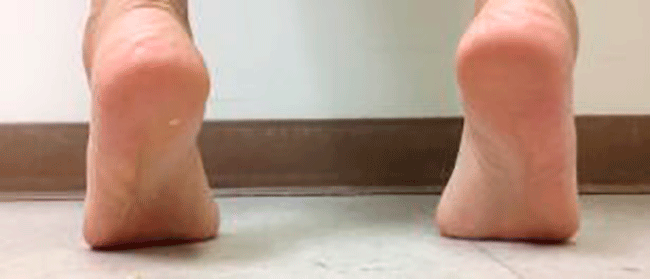 Test Double y Single Heel Rise para inestabilidad en el tobillo
